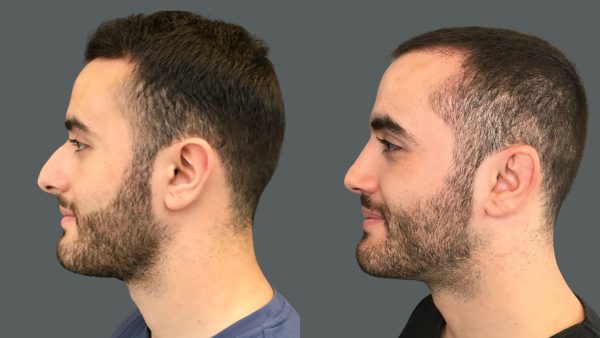 before and after image of man looking left